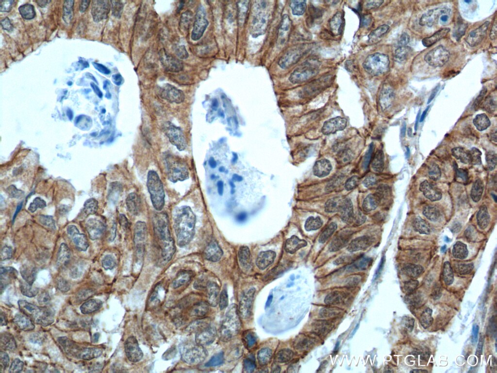 Immunohistochemistry (IHC) staining of human colon cancer tissue using p120 Catenin Polyclonal antibody (12180-1-AP)