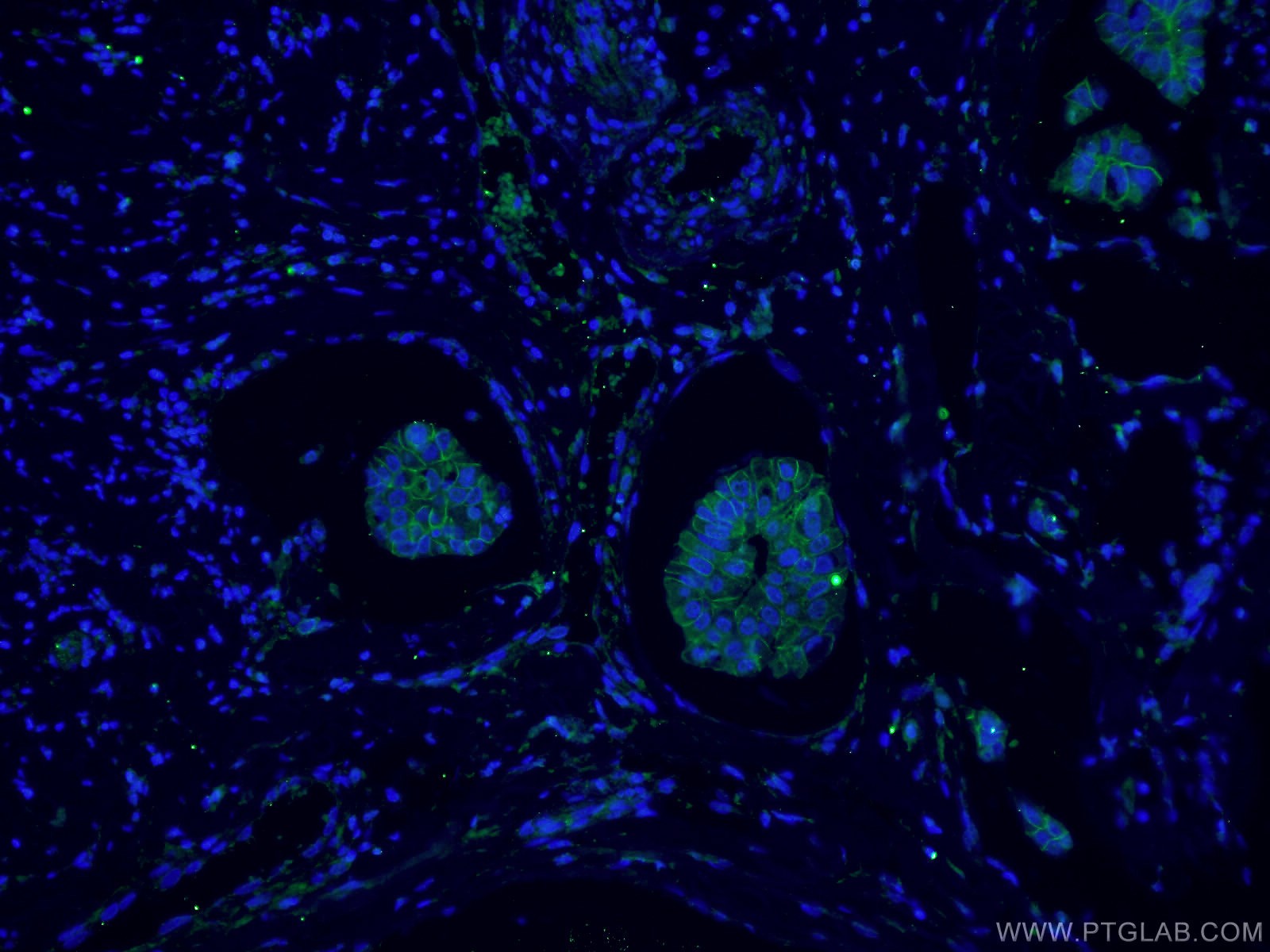 Immunofluorescence (IF) / fluorescent staining of human breast cancer tissue using p120 Catenin Monoclonal antibody (66208-1-Ig)