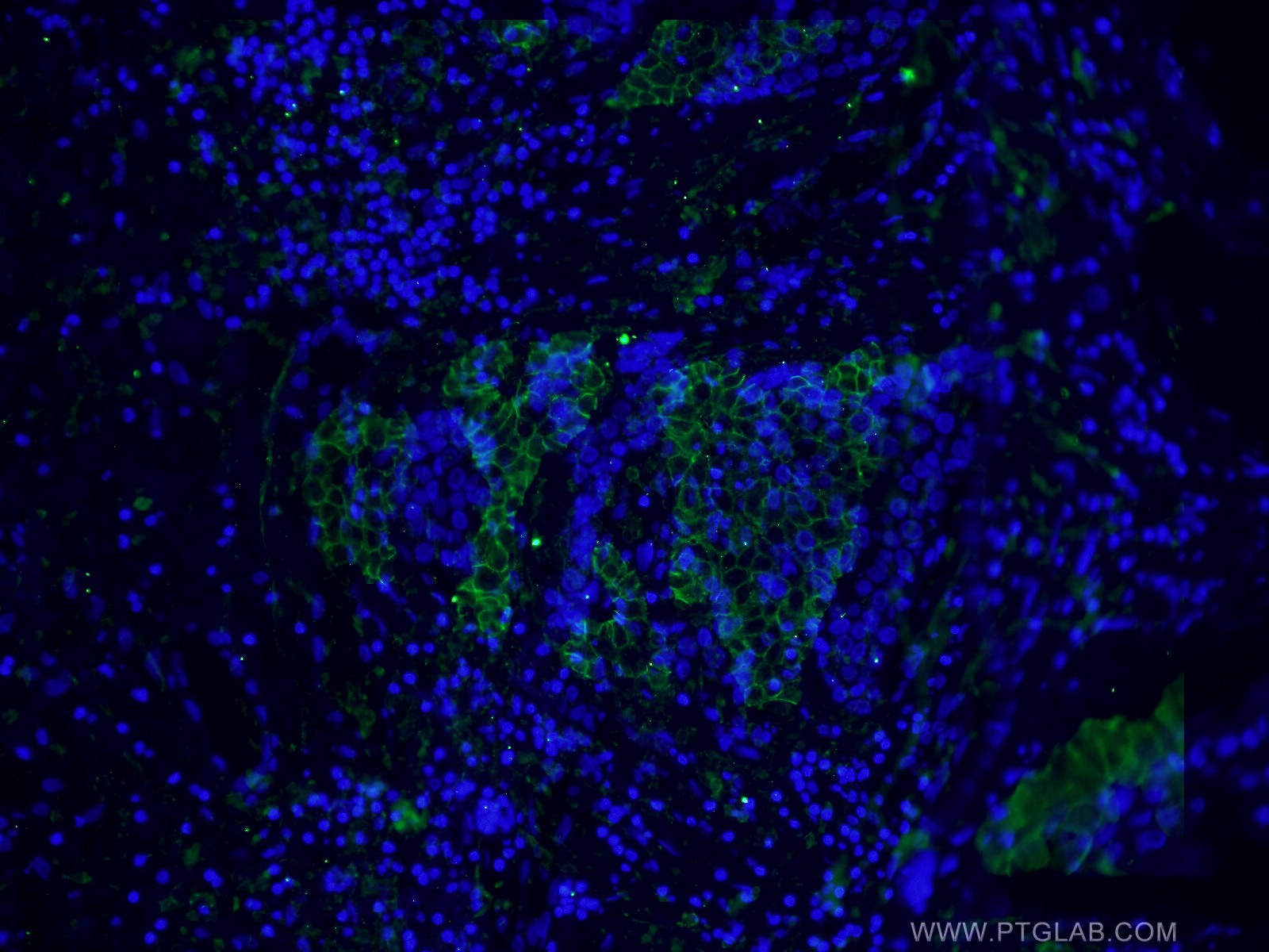 Immunofluorescence (IF) / fluorescent staining of human breast cancer tissue using p120 Catenin Monoclonal antibody (66208-1-Ig)