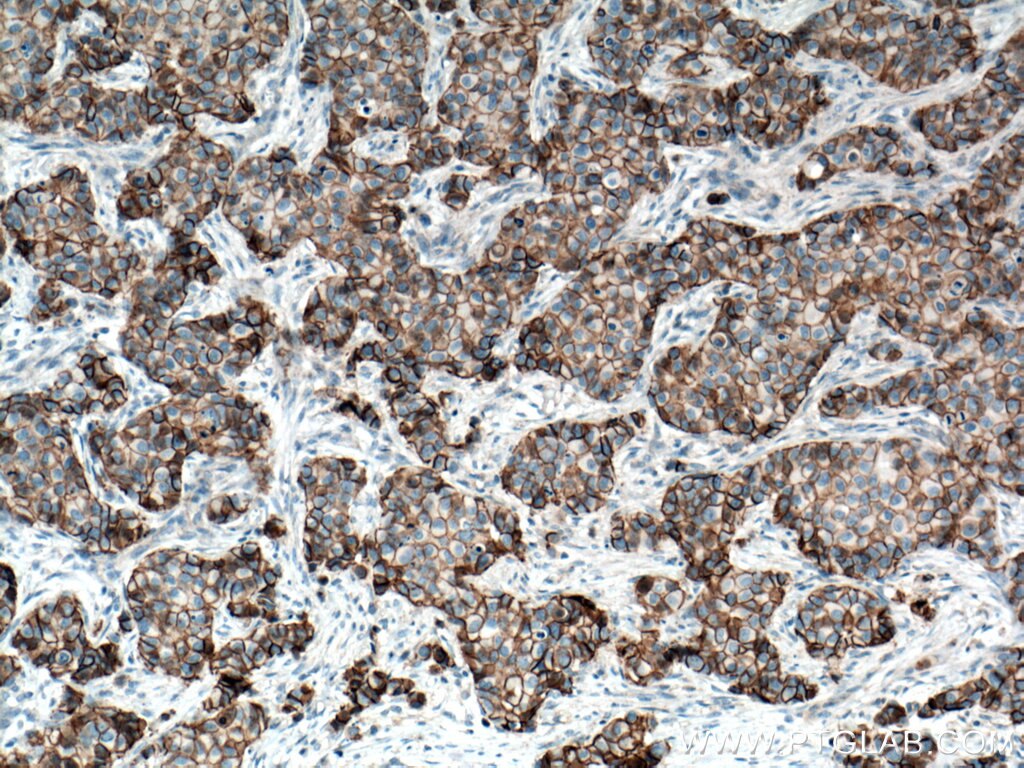 Immunohistochemistry (IHC) staining of human breast cancer tissue using p120 Catenin Monoclonal antibody (66208-1-Ig)