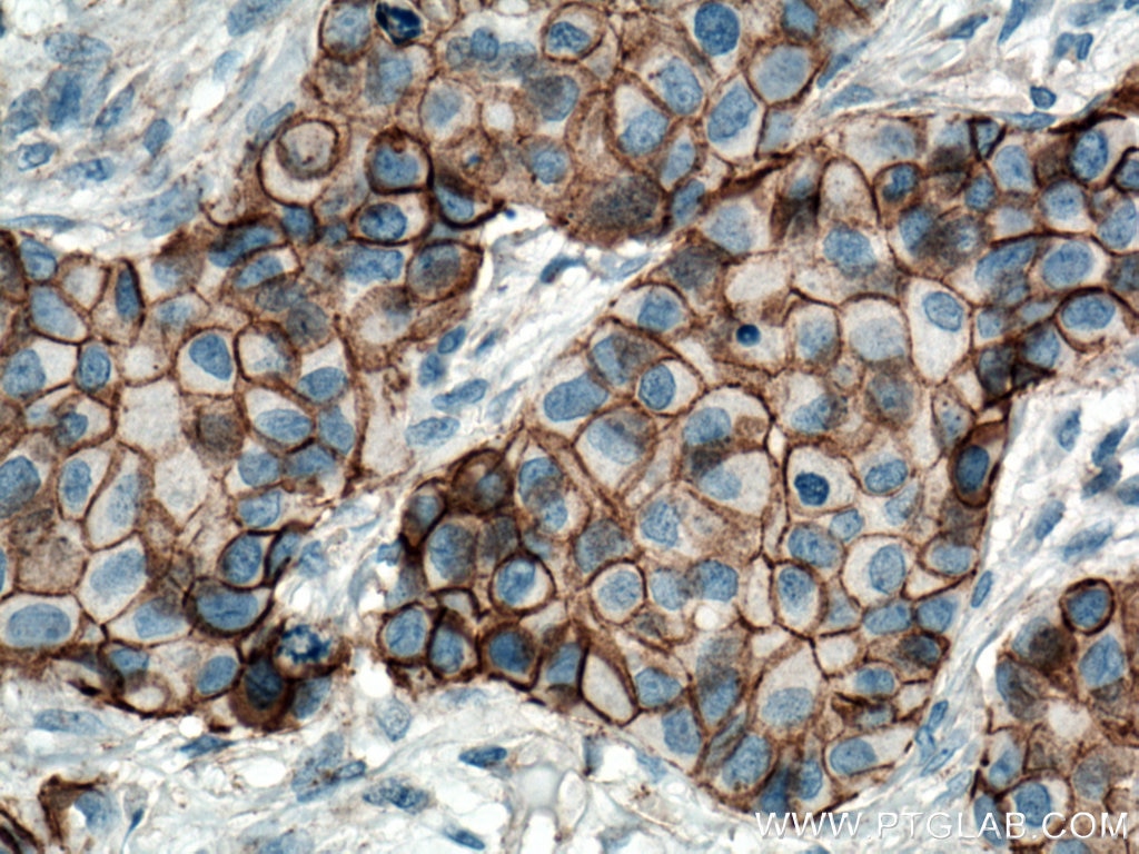Immunohistochemistry (IHC) staining of human breast cancer tissue using p120 Catenin Monoclonal antibody (66208-1-Ig)
