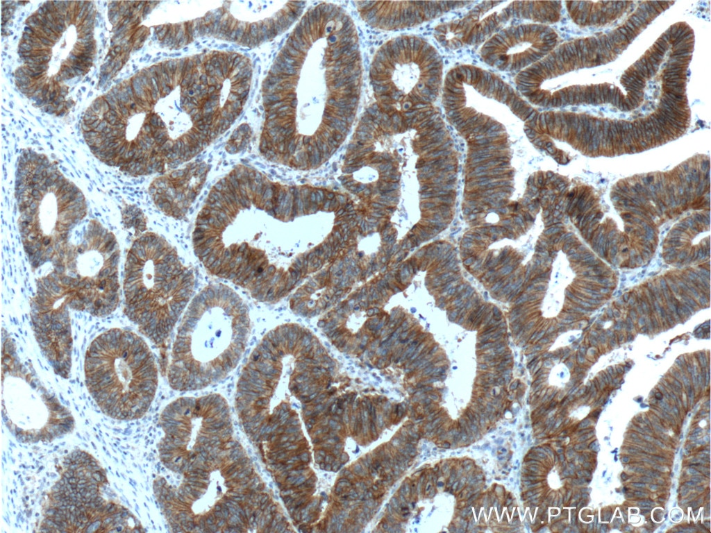 Immunohistochemistry (IHC) staining of human colon cancer tissue using p120 Catenin Monoclonal antibody (66208-1-Ig)