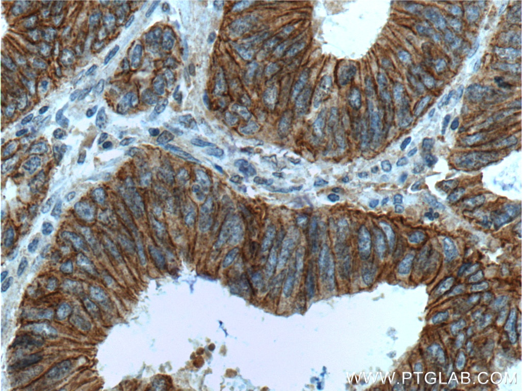 Immunohistochemistry (IHC) staining of human colon cancer tissue using p120 Catenin Monoclonal antibody (66208-1-Ig)