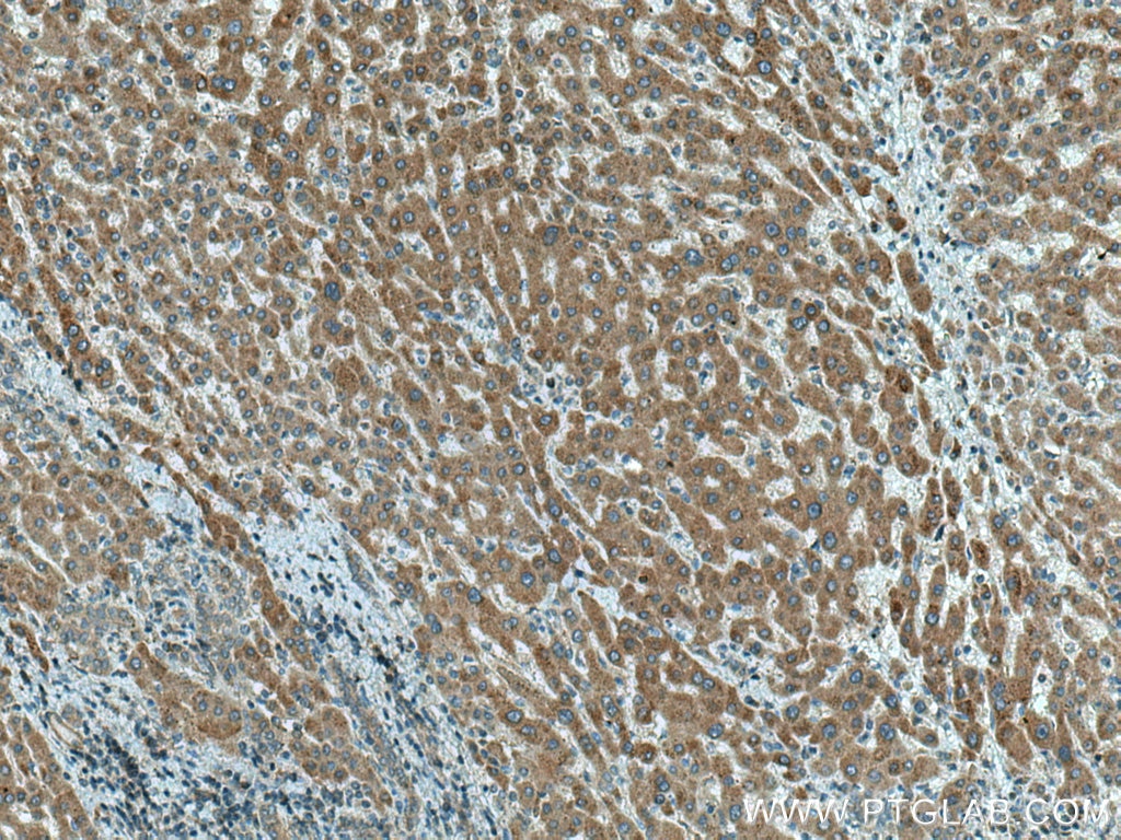Immunohistochemistry (IHC) staining of human liver cancer tissue using CTP synthase Polyclonal antibody (15914-1-AP)