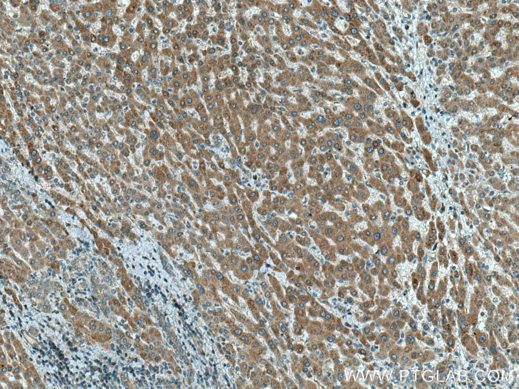 IHC staining of human liver cancer using 15914-1-AP