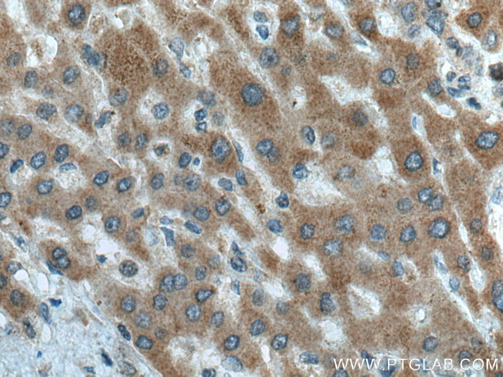 Immunohistochemistry (IHC) staining of human liver cancer tissue using CTP synthase Polyclonal antibody (15914-1-AP)