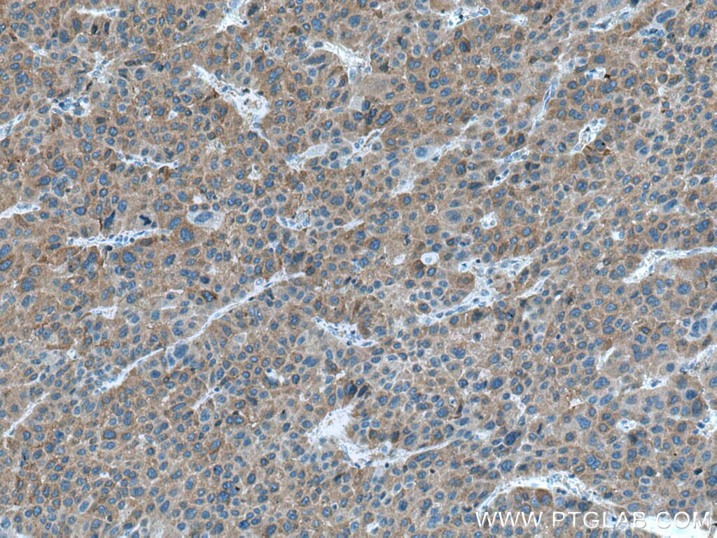 IHC staining of human liver cancer using 15914-1-AP