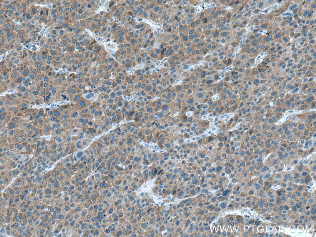 Immunohistochemistry (IHC) staining of human liver cancer tissue using CTP synthase Polyclonal antibody (15914-1-AP)