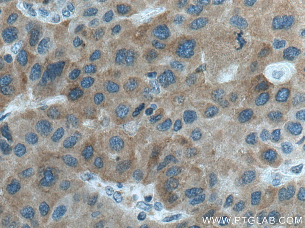 Immunohistochemistry (IHC) staining of human liver cancer tissue using CTP synthase Polyclonal antibody (15914-1-AP)