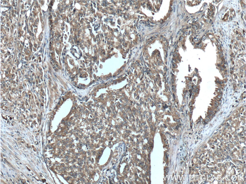 Immunohistochemistry (IHC) staining of human prostate cancer tissue using CTPS2 Polyclonal antibody (12852-1-AP)