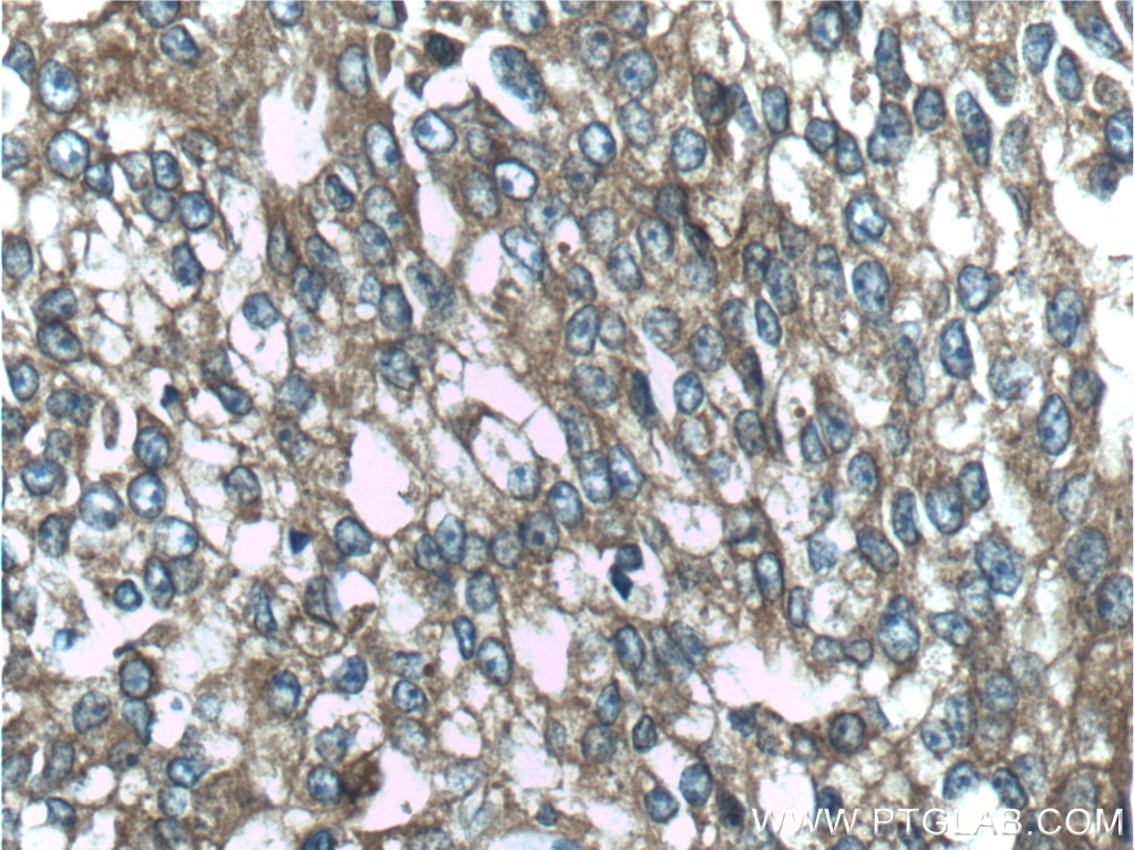 Immunohistochemistry (IHC) staining of human prostate cancer tissue using CTPS2 Polyclonal antibody (12852-1-AP)