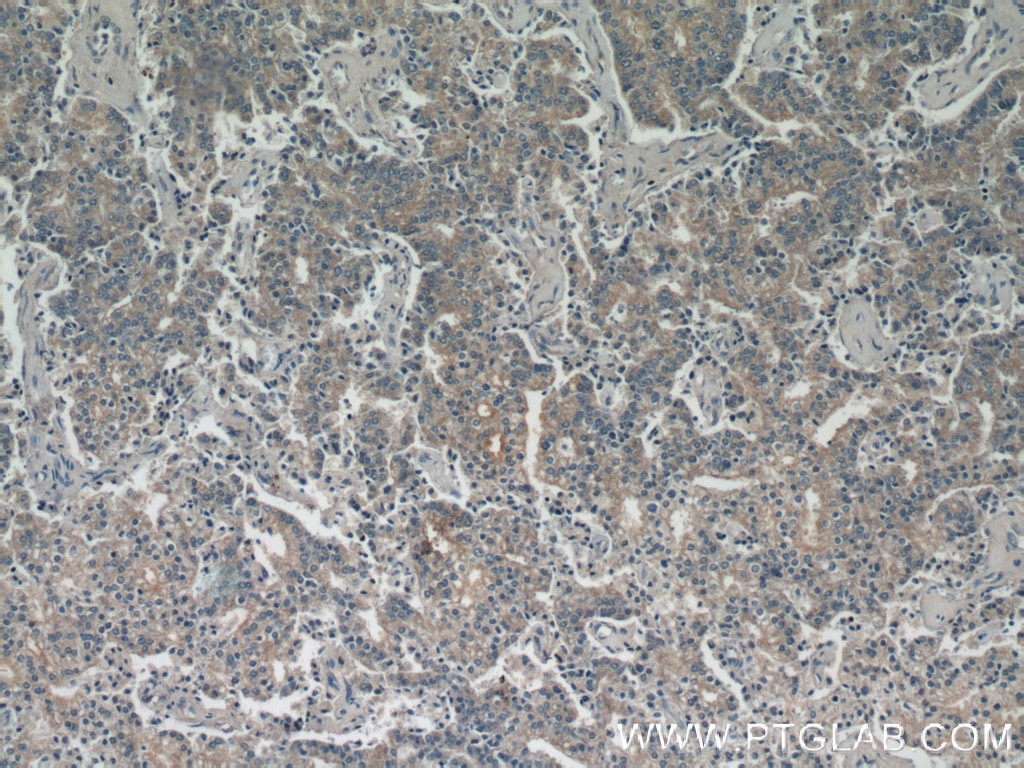 Immunohistochemistry (IHC) staining of human prostate cancer tissue using CTPS2 Polyclonal antibody (12852-1-AP)