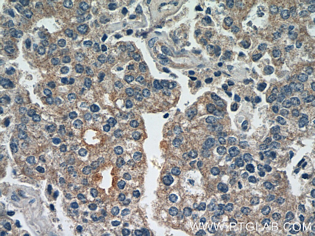 Immunohistochemistry (IHC) staining of human prostate cancer tissue using CTPS2 Polyclonal antibody (12852-1-AP)