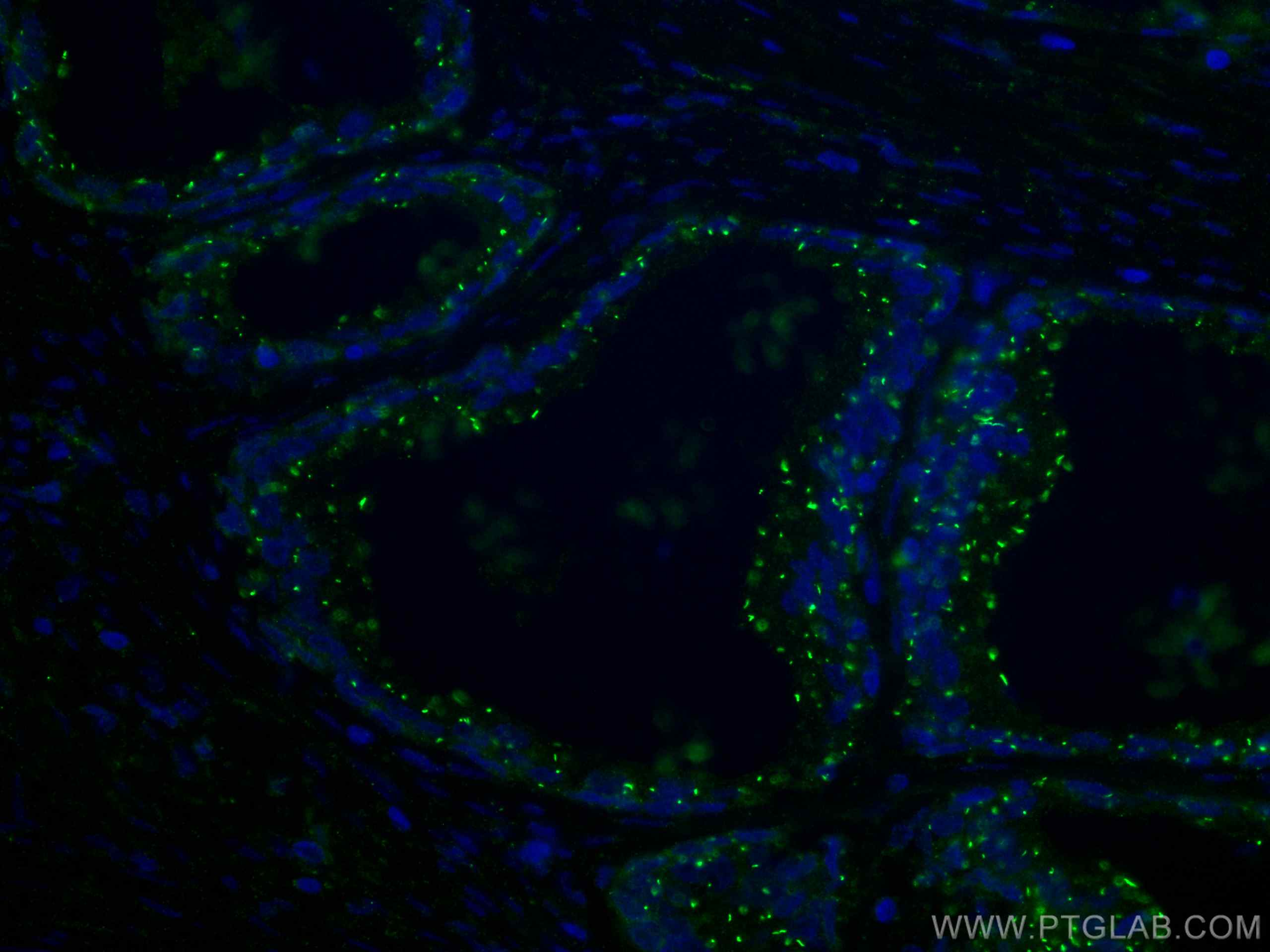Immunofluorescence (IF) / fluorescent staining of human prostate cancer tissue using CTPS2 Monoclonal antibody (67734-1-Ig)