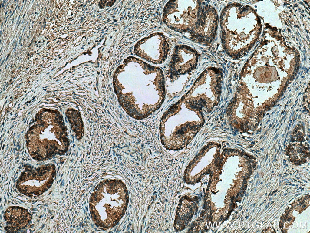 Immunohistochemistry (IHC) staining of human prostate cancer tissue using CTPS2 Monoclonal antibody (67734-1-Ig)