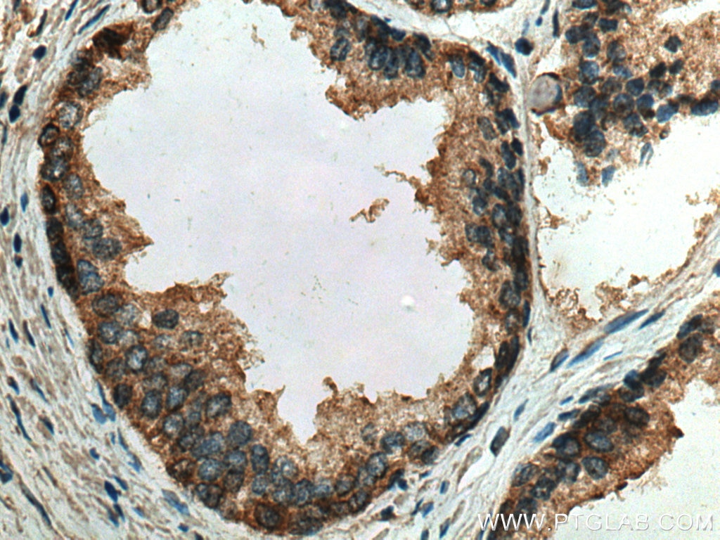 IHC staining of human prostate cancer using 67734-1-Ig