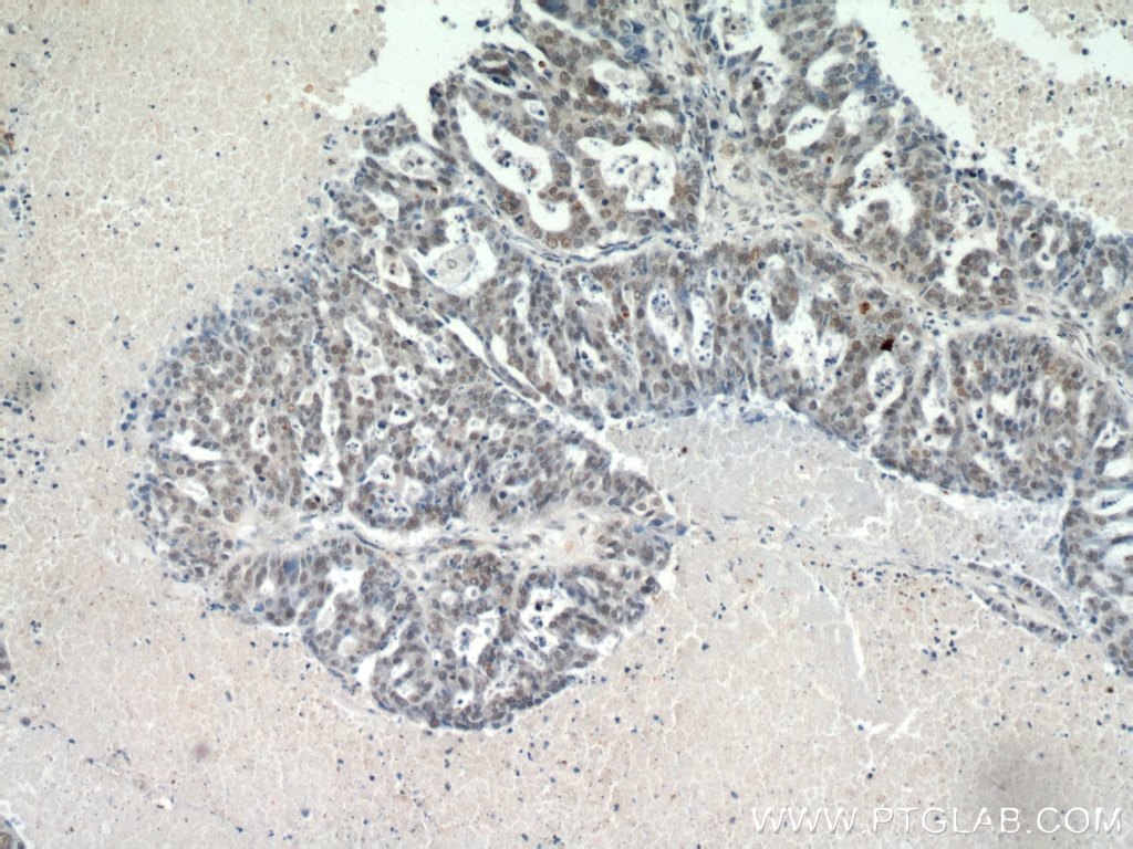 Immunohistochemistry (IHC) staining of human ovary tumor tissue using CTR9 Polyclonal antibody (20672-1-AP)