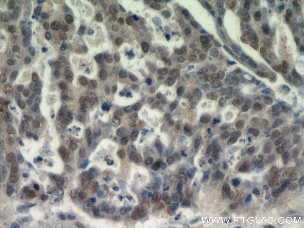 Immunohistochemistry (IHC) staining of human ovary tumor tissue using CTR9 Polyclonal antibody (20672-1-AP)