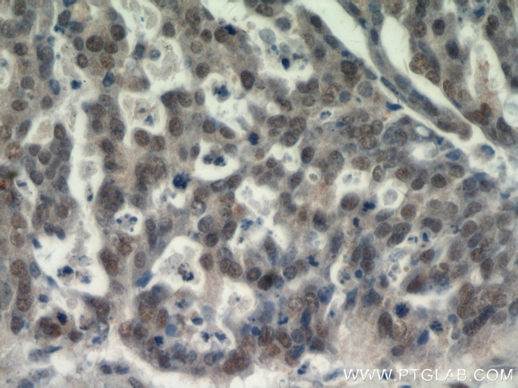 IHC staining of human ovary tumor using 20672-1-AP