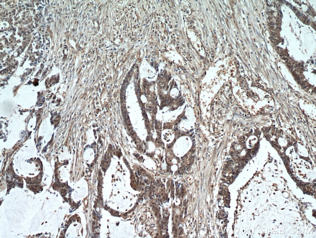 Immunohistochemistry (IHC) staining of human colon cancer tissue using CTR9 Polyclonal antibody (21264-1-AP)