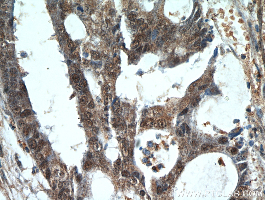 Immunohistochemistry (IHC) staining of human colon cancer tissue using CTR9 Polyclonal antibody (21264-1-AP)