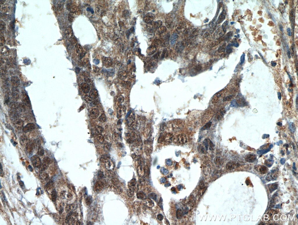 IHC staining of human colon cancer using 21264-1-AP