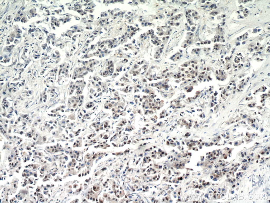 IHC staining of human breast cancer using 21264-1-AP