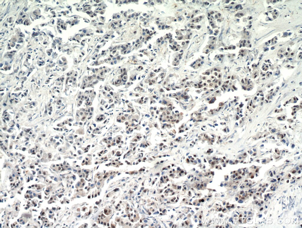 Immunohistochemistry (IHC) staining of human breast cancer tissue using CTR9 Polyclonal antibody (21264-1-AP)