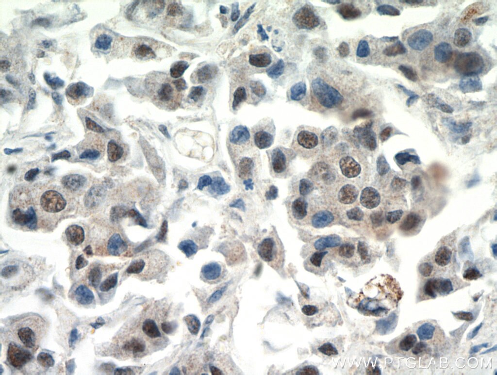 Immunohistochemistry (IHC) staining of human breast cancer tissue using CTR9 Polyclonal antibody (21264-1-AP)
