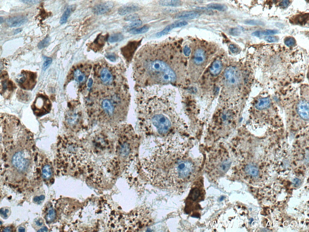 IHC staining of human liver cancer using 15020-1-AP