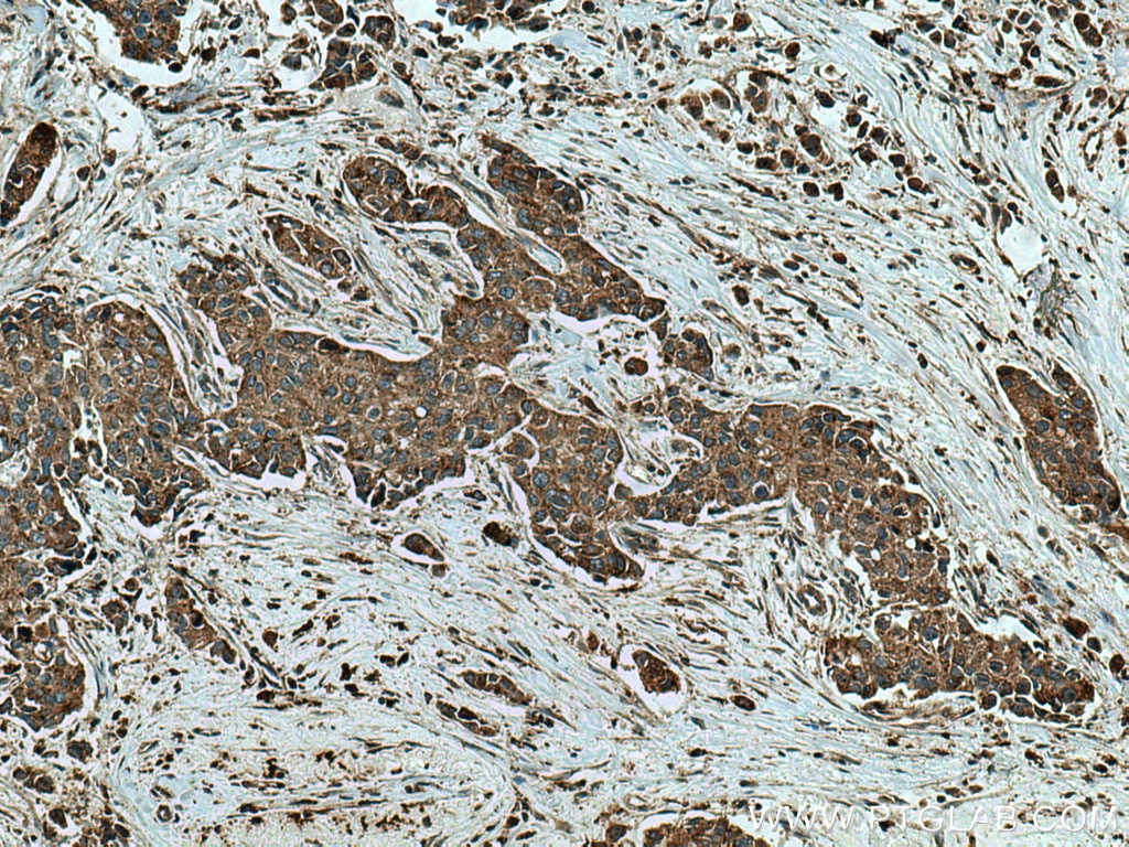 Immunohistochemistry (IHC) staining of human breast cancer tissue using Cathepsin A Polyclonal antibody (15020-1-AP)