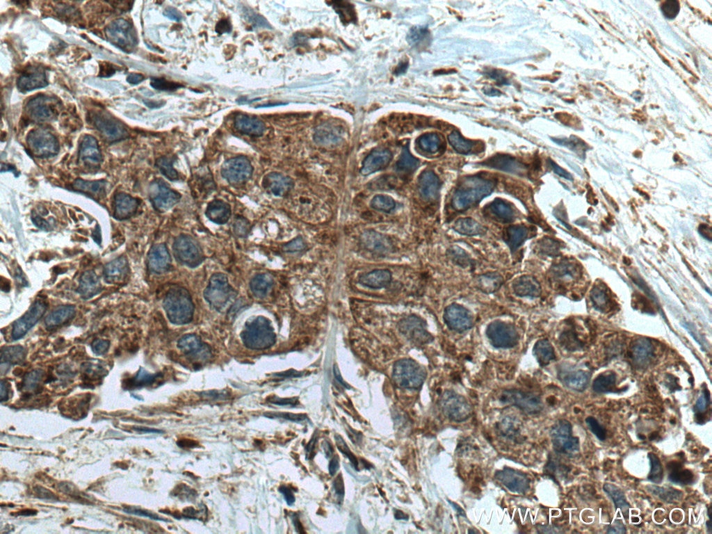 Immunohistochemistry (IHC) staining of human breast cancer tissue using Cathepsin A Polyclonal antibody (15020-1-AP)