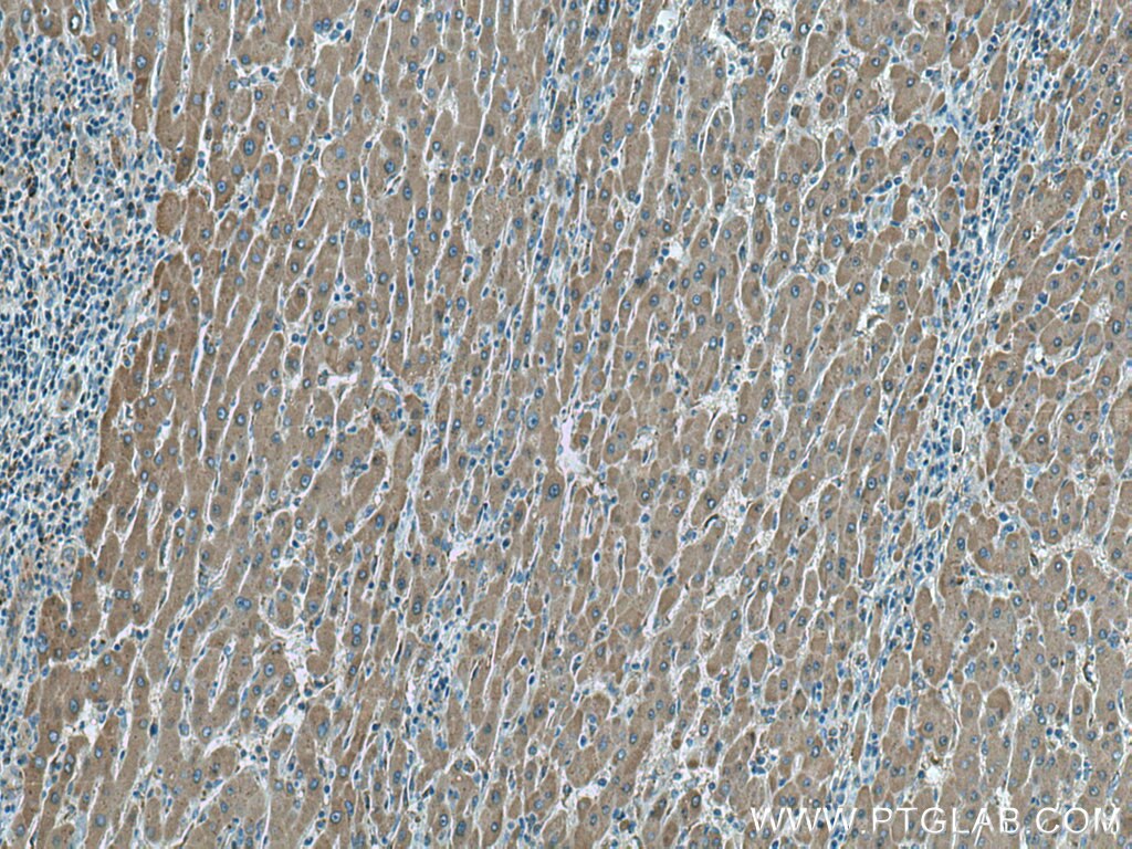 IHC staining of human liver cancer using 15020-1-AP