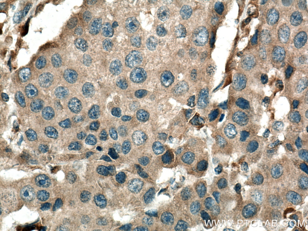 Immunohistochemistry (IHC) staining of human breast cancer tissue using Cathepsin B Polyclonal antibody (12216-1-AP)