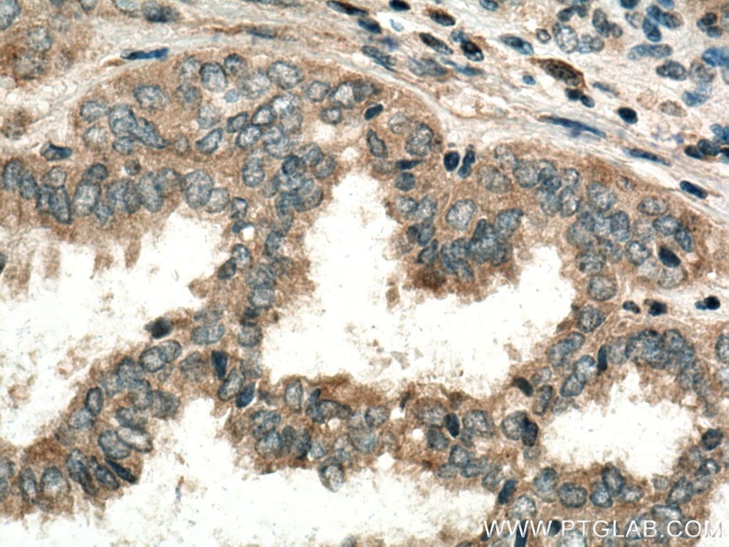 IHC staining of human ovary tumor using 12216-1-AP