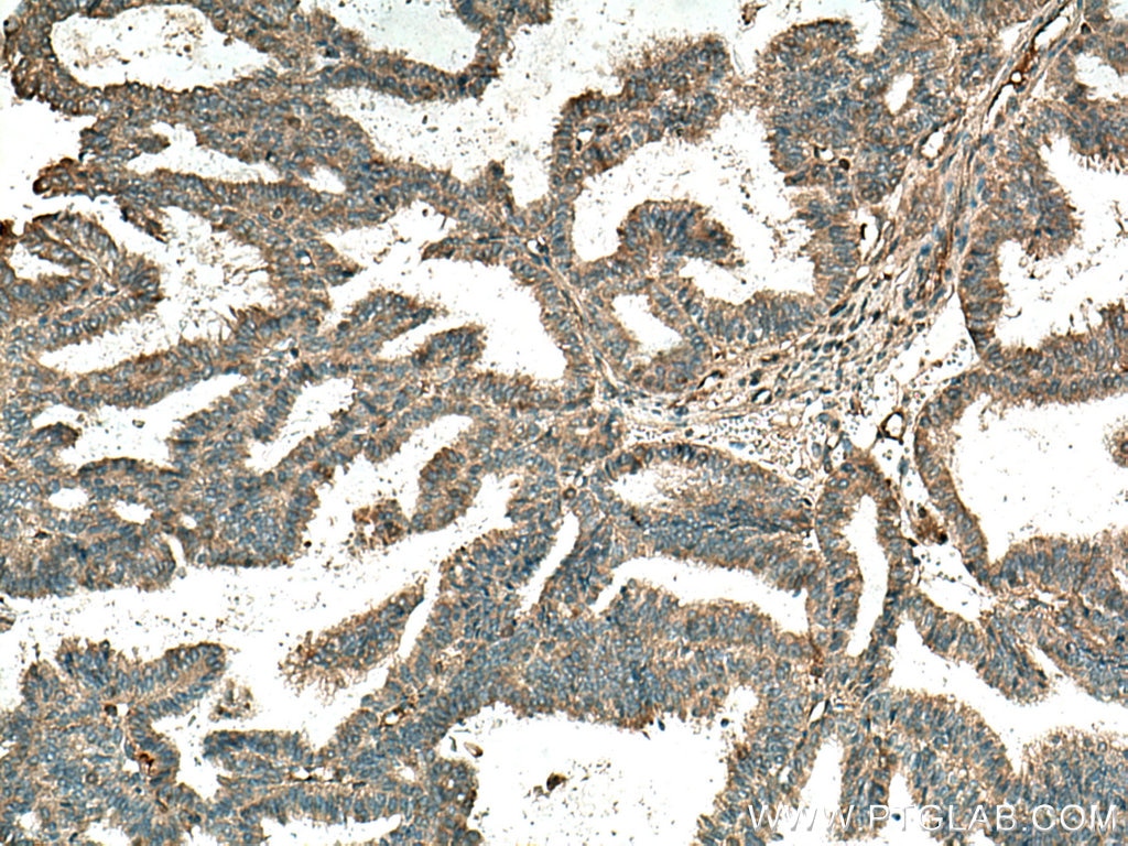 Immunohistochemistry (IHC) staining of human ovary tumor tissue using Cathepsin B Polyclonal antibody (12216-1-AP)