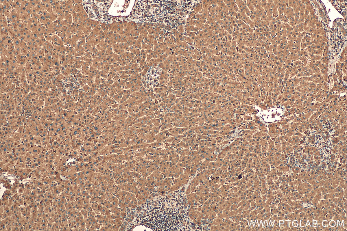 Immunohistochemistry (IHC) staining of human hepatocirrhosis tissue using Cathepsin D Polyclonal antibody (21327-1-AP)