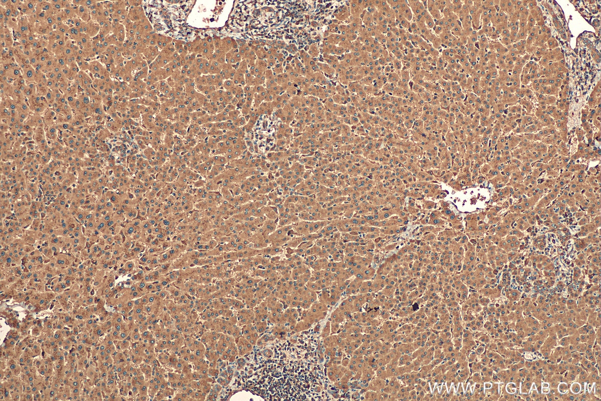 IHC staining of human hepatocirrhosis using 21327-1-AP