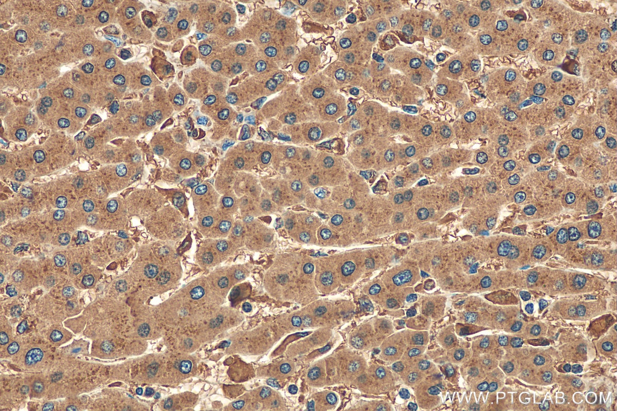 Immunohistochemistry (IHC) staining of human hepatocirrhosis tissue using Cathepsin D Polyclonal antibody (21327-1-AP)