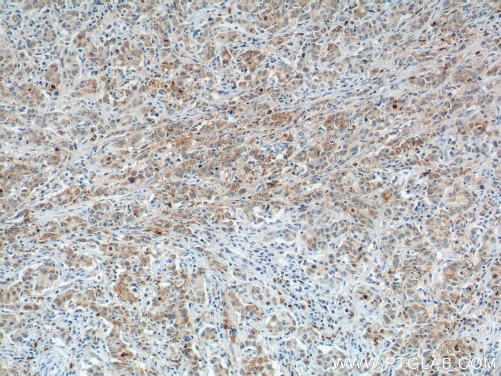 Immunohistochemistry (IHC) staining of human stomach cancer tissue using Cathepsin F Polyclonal antibody (11055-1-AP)
