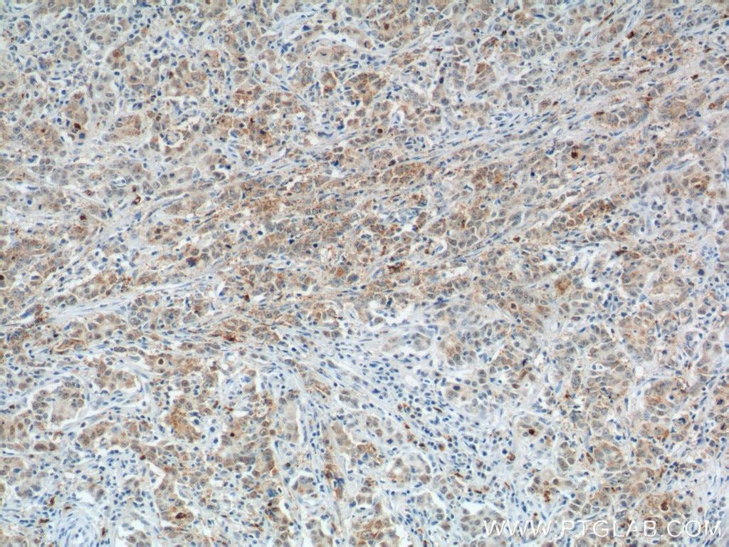 Immunohistochemistry (IHC) staining of human stomach cancer tissue using Cathepsin F Polyclonal antibody (11055-1-AP)