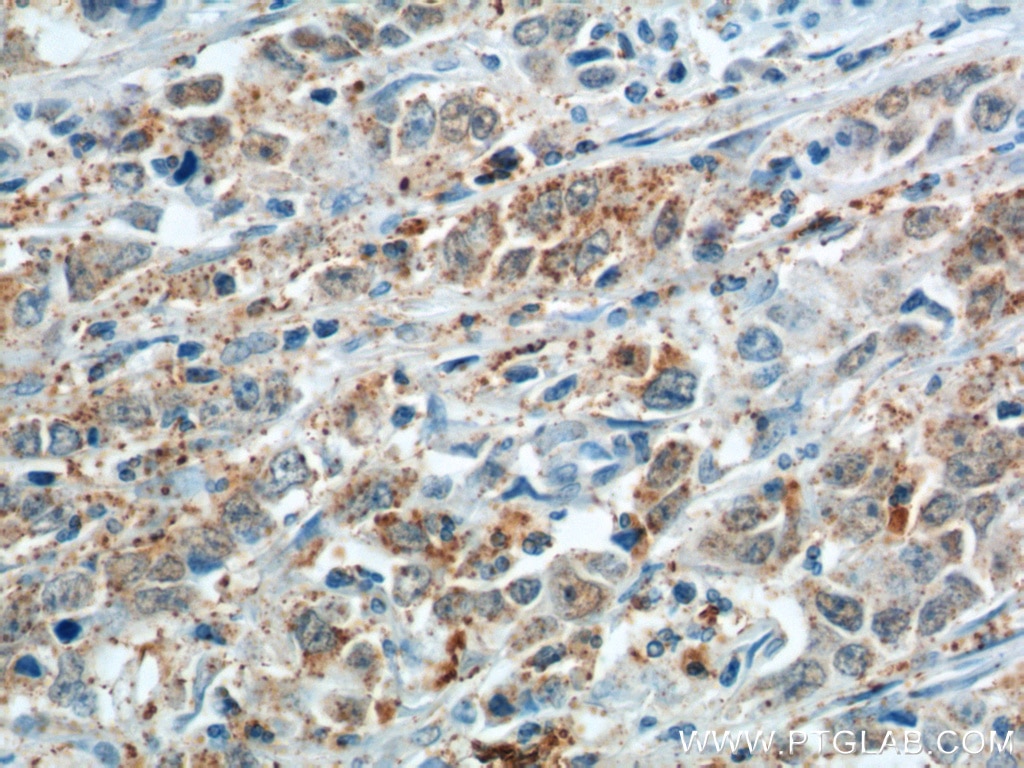 Immunohistochemistry (IHC) staining of human stomach cancer tissue using Cathepsin F Polyclonal antibody (11055-1-AP)