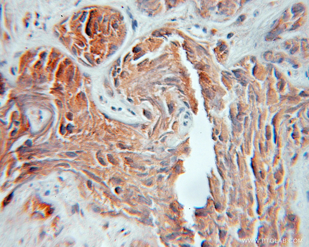 Immunohistochemistry (IHC) staining of human prostate cancer tissue using Cathepsin F Polyclonal antibody (11055-1-AP)