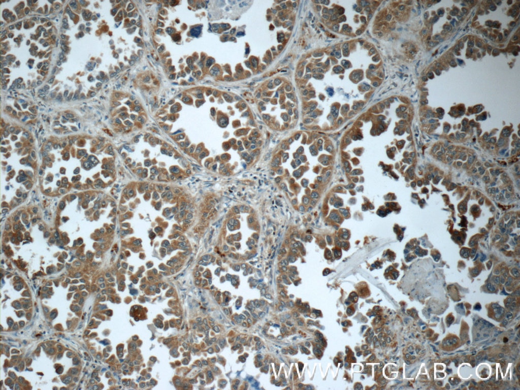Immunohistochemistry (IHC) staining of human lung cancer tissue using Cathepsin K Polyclonal antibody (11239-1-AP)