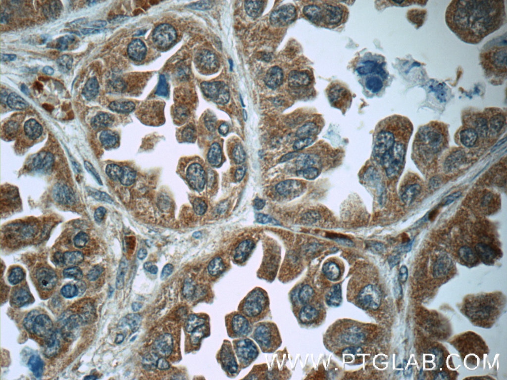 Immunohistochemistry (IHC) staining of human lung cancer tissue using Cathepsin K Polyclonal antibody (11239-1-AP)