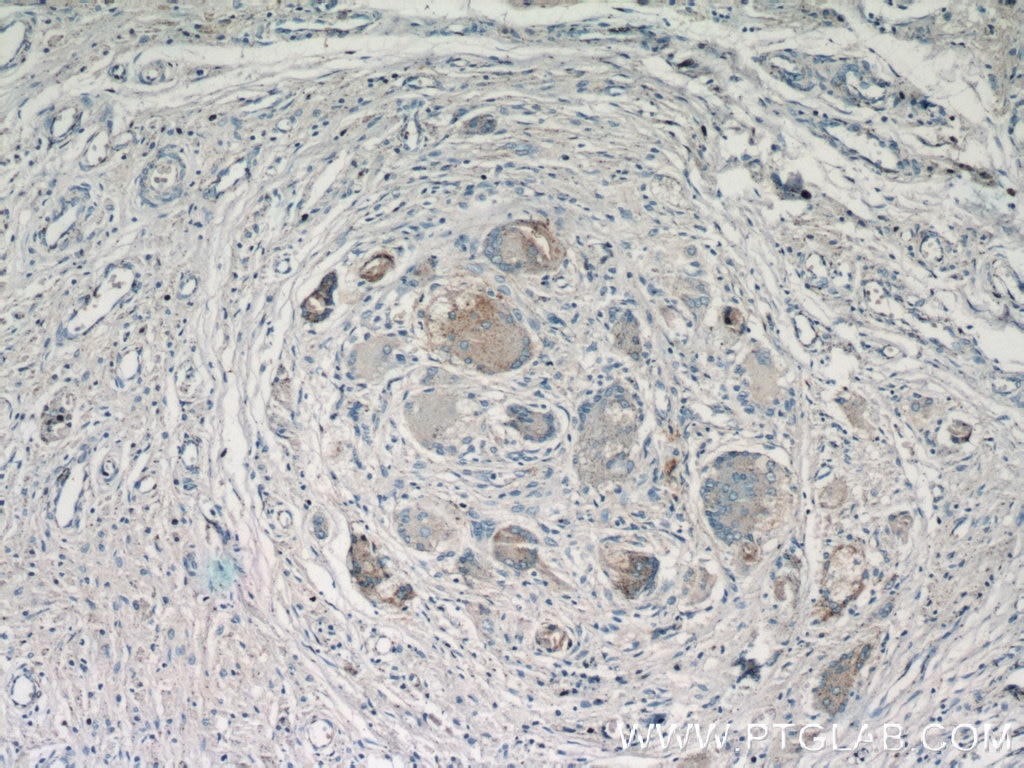 Immunohistochemistry (IHC) staining of human osteosarcoma tissue using Cathepsin K Polyclonal antibody (11239-1-AP)