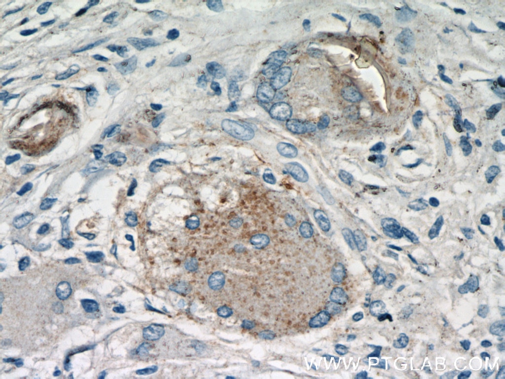 Immunohistochemistry (IHC) staining of human osteosarcoma tissue using Cathepsin K Polyclonal antibody (11239-1-AP)