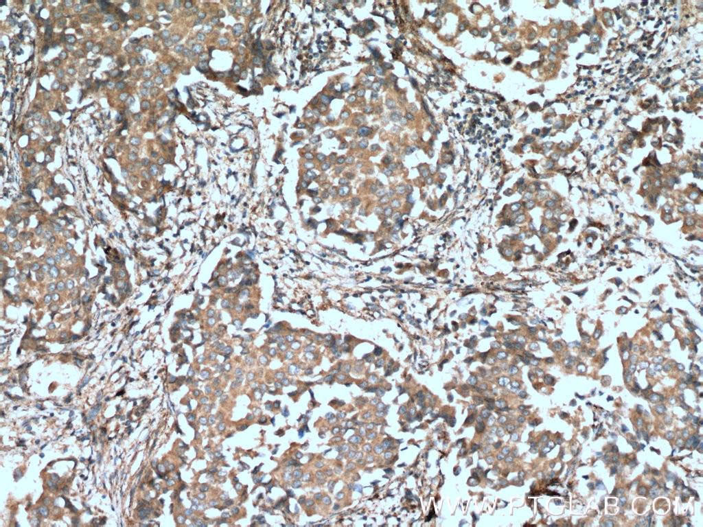 Immunohistochemistry (IHC) staining of human breast cancer tissue using Cathepsin K Polyclonal antibody (11239-1-AP)