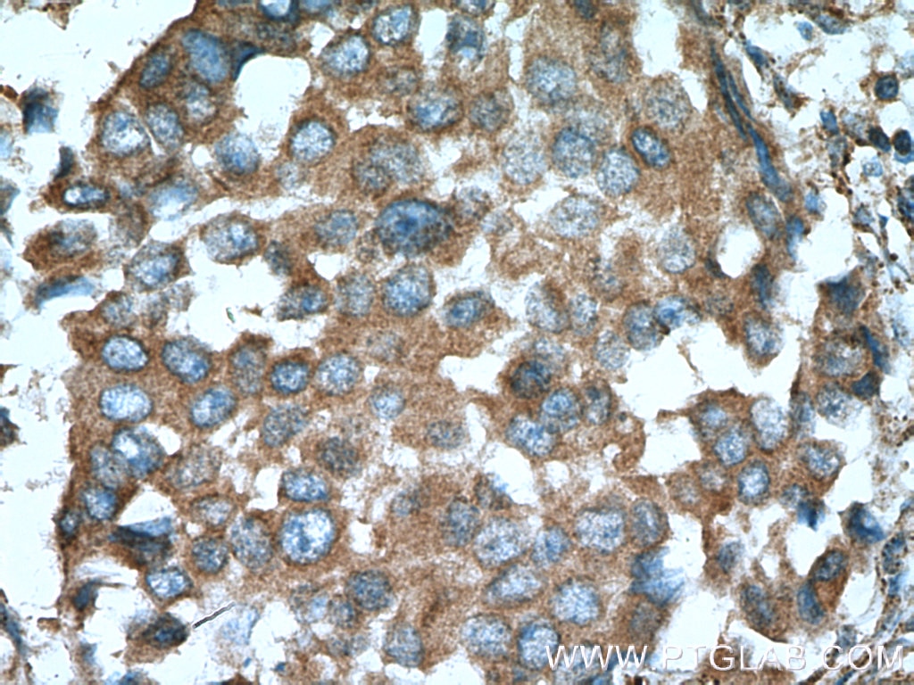 Immunohistochemistry (IHC) staining of human breast cancer tissue using Cathepsin K Polyclonal antibody (11239-1-AP)