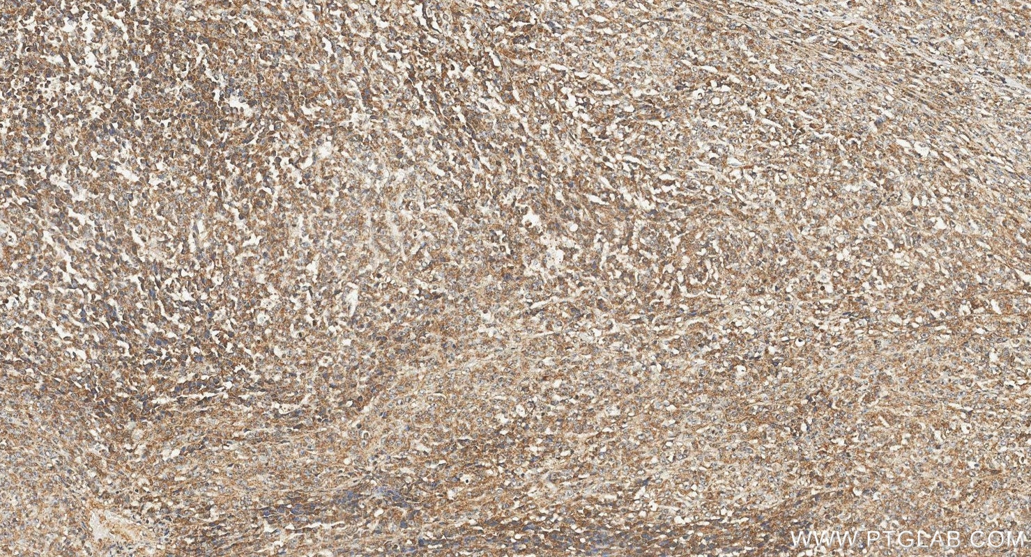 IHC staining of human malignant melanoma using 11239-1-AP Immunohistochemistry (IHC) staining of human malignant melanoma tissue using Cathepsin K Polyclonal antibody (11239-1-AP)